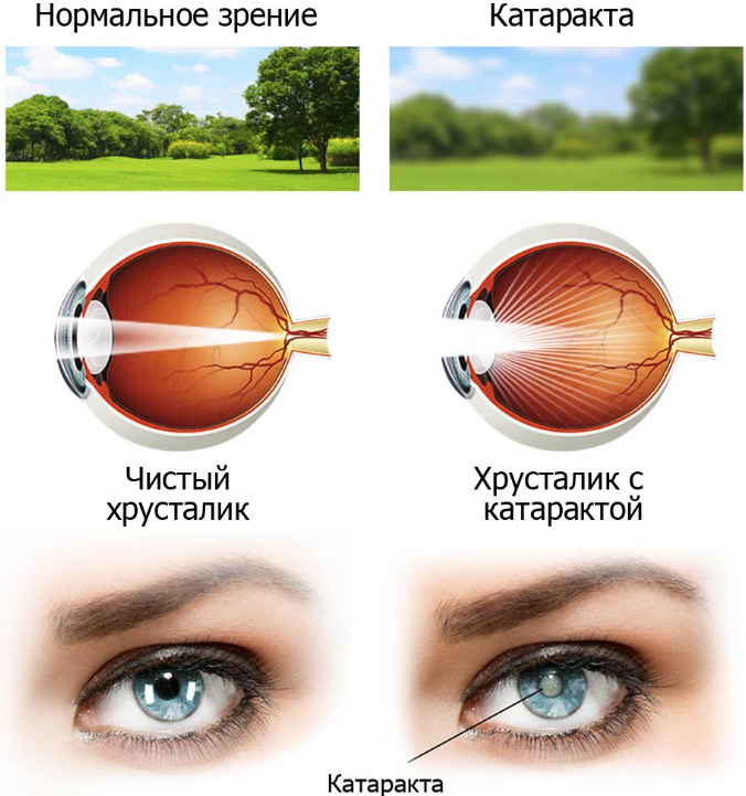От катаракты простое лечение, в обычной травке - глаз спасение