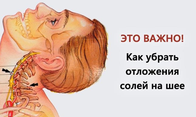 Убираем отложения солей на шее
