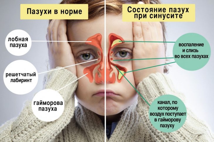 4 мощных средства против СИНУСИТА + простой трюк, который очистит пазухи всего за 20 секунд!