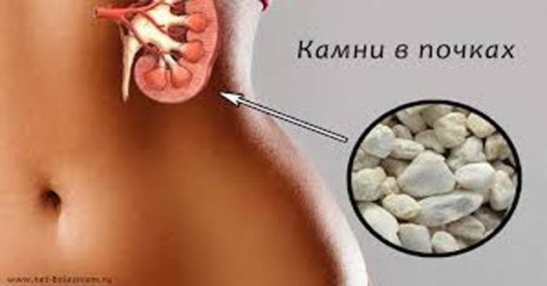 С этим лекарством камни в почках и желчном «растают»! Врачи рекомендуют!