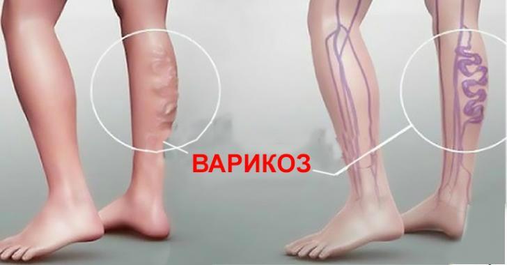 Врач-флеболог: «Запомните все! Варикоз не любит, когда ноги…»