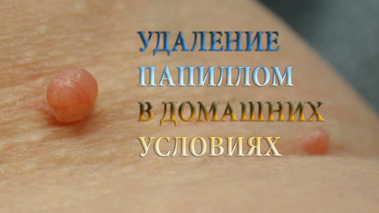 Удали Фибромы без операции!!! Рецепт в видео!