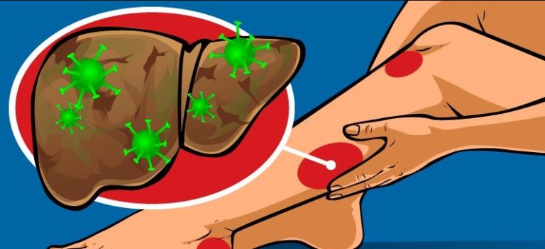 Давно чистили печень? 9 признаков того, что она переполнена токсинами!