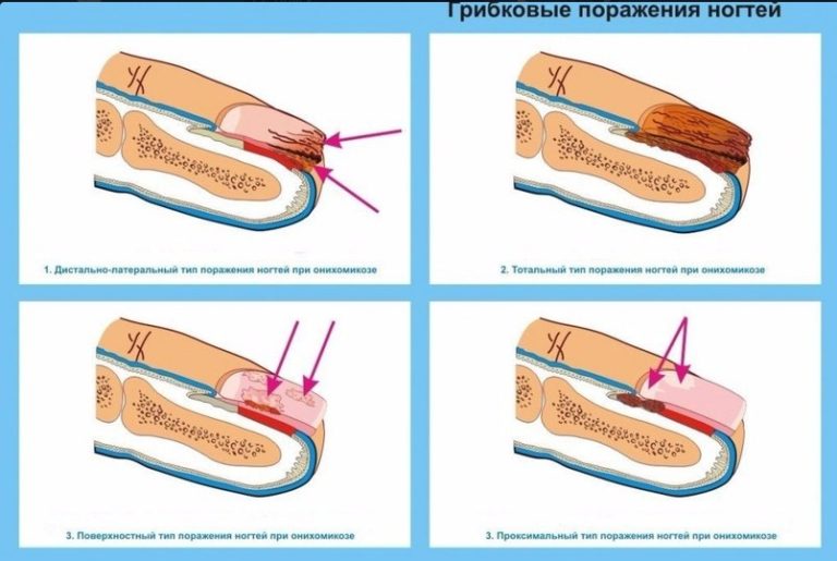 Как вылечить грибок на ногтях?