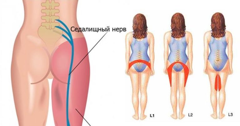 Как же разблокировать седалищный нерв: 2 простых способа снять боль