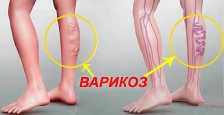 Натуральное Средство против варикоза вен: рецепт, применение