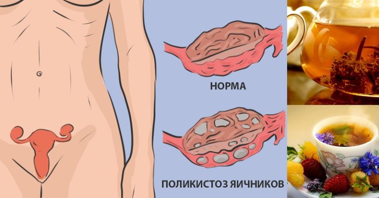 Натуральное средство для лечения поликистоза яичников: никаких гормонов