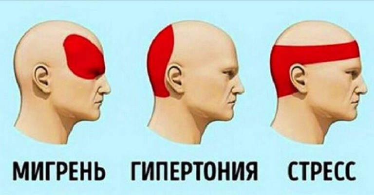 За 5 минут избавиться от головной боли без таблеток? Это просто!