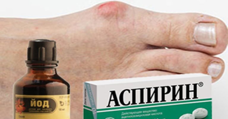 Эти народные способы быстро уберут косточку на ноге. Большая шишка на ноге растает за неделю!