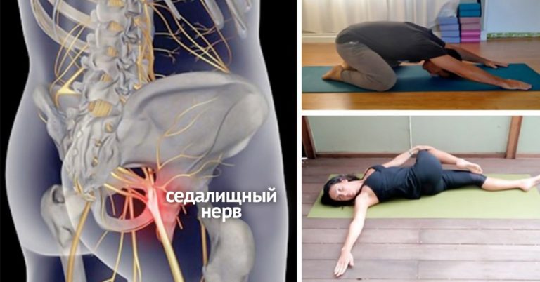 8 простых упражнений, которые помогут избавиться от защемления седалищного нерва!