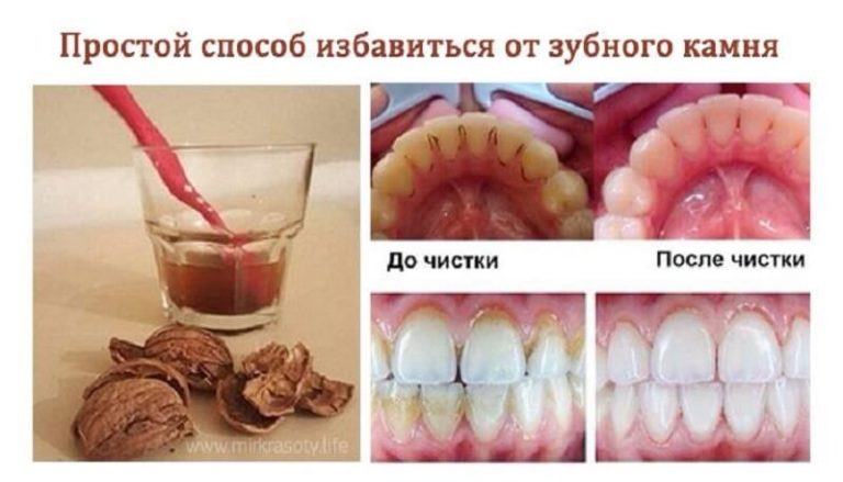 Как избавиться от зубного камня без посещения стоматолога?