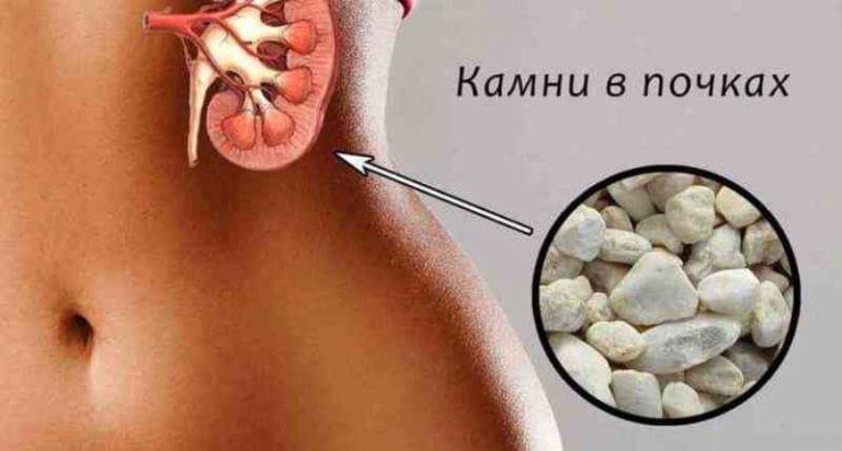 Делюсь рецептом растворения камней в почках, который неоднократно проверен на родственниках и знакомых!