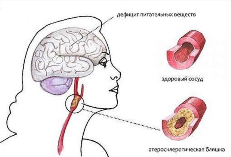 Дыхательна гимнастика от тяжелого склероза: 20 лет делаю и болезнь в узде держу