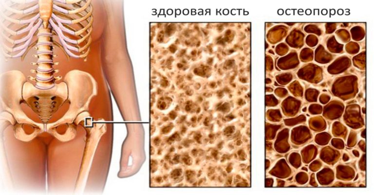 Эти 3 продукта — лучшие защитники костей от остеопороза