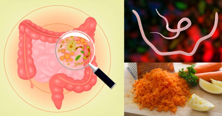 Кишечные паразиты: 6 самых мощных продуктов для 100% устранения
