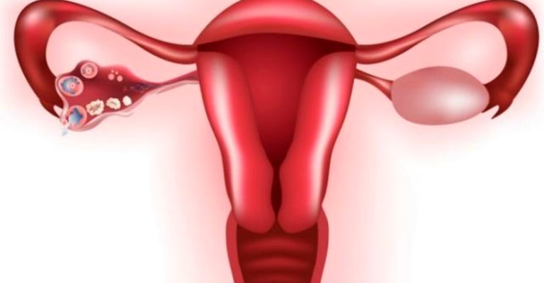 Кисты яичников: причины, симптомы и рецепты для быстрого устранения