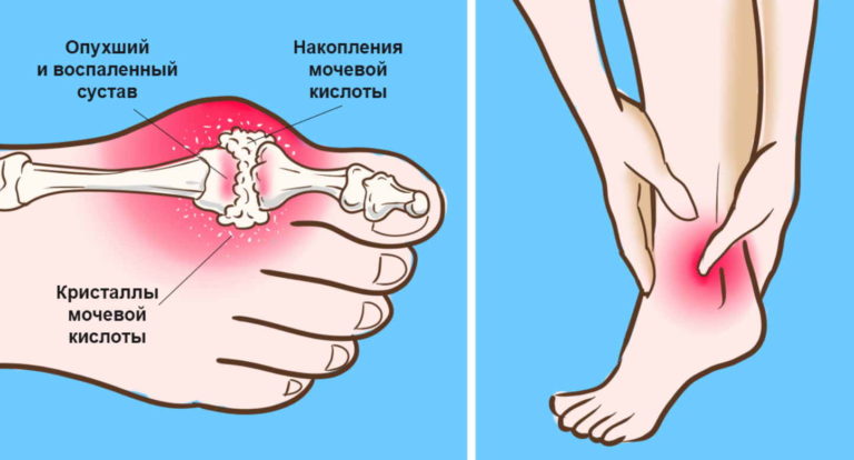 Мочевая кислота «приглашает» подагру. Как вывести ее излишки из организма