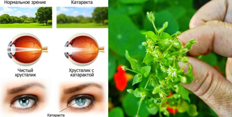 От катаракты простое лечение, в обычной травке — глаз спасение