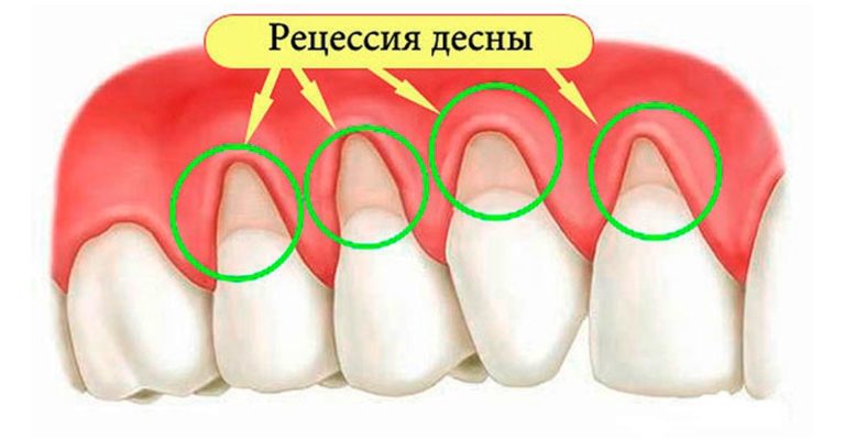 Рецессия десен: 4 домашних средства для быстрого устранения
