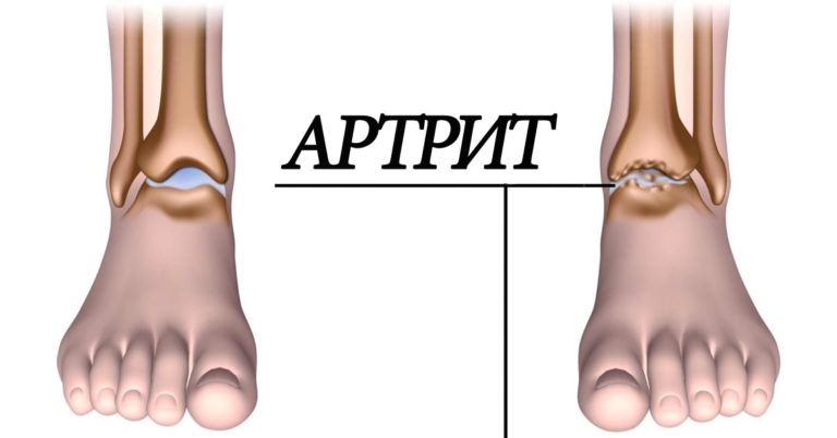 Артрит: 5 продуктов устранят воспаление суставов и избавят от боли