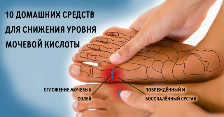 ИЗБАВЬСЯ от мочевой кислоты и вылечи подагру. 10 натуральных средств