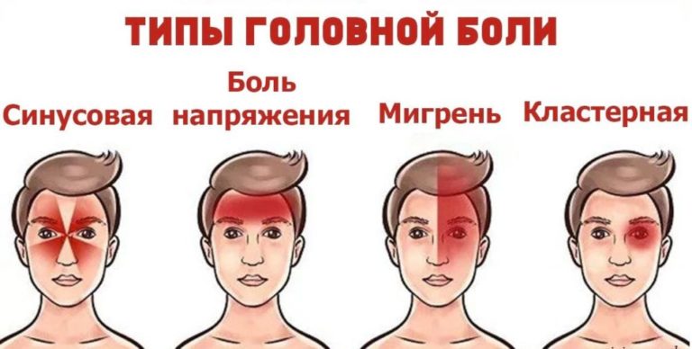 4 вида головной боли. Вот как правильно избавиться от каждой из них