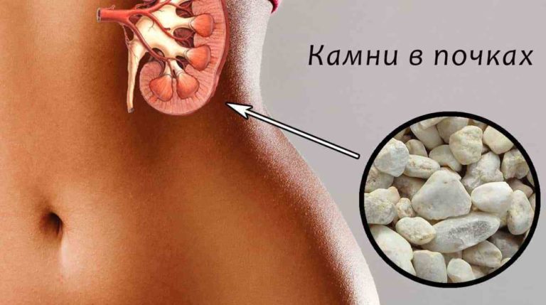 Поделюсь рецептом растворения камней в почках, который неоднократно проверен на родственниках и знакомых