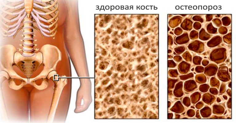 Эти 3 продукта — лучшие защитники костей от остеопороза