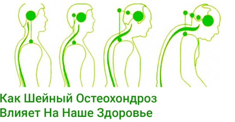 Осторожно. Болит Шея