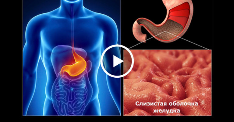 Вы ЭТО Должны Увидеть — Причины и Лечение Хронического Гастрита