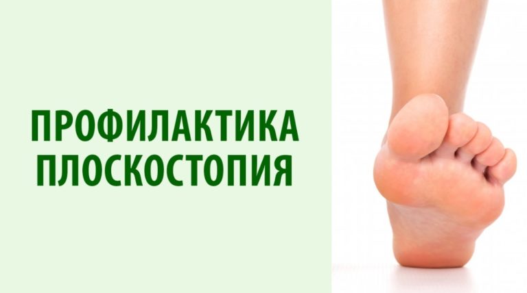 Эффективные Техники Для Профилактики И Терапии Плоскостопия
