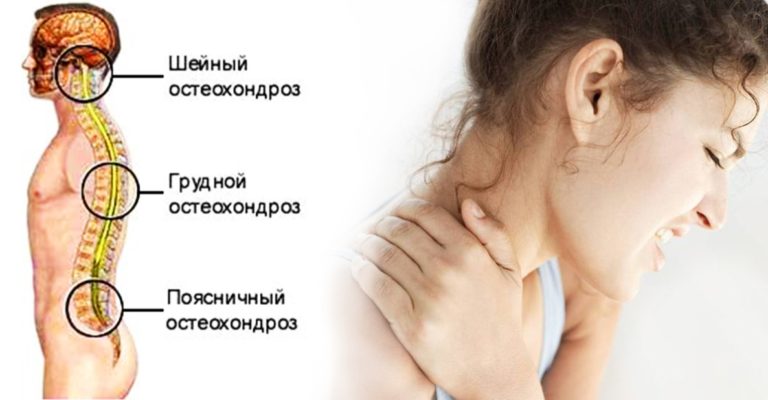 Этот Рецепт Поможет Вам При Остеохондрозе и Отложении Солей