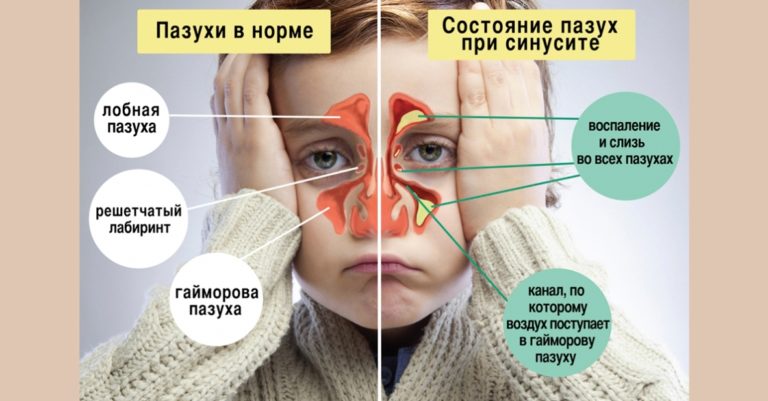 Гайморит: лечение народными средствами