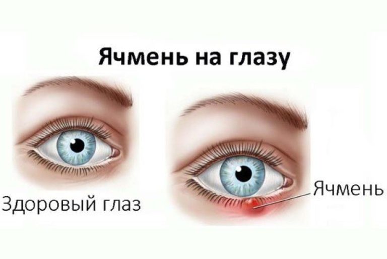 Как Избавиться от ЯЧМЕНЯ На Глазу