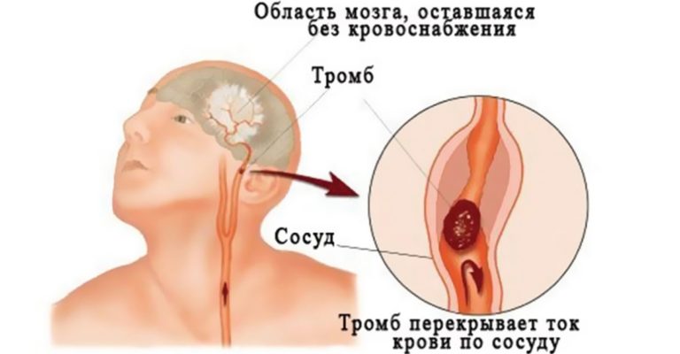 Народные средства для улучшения мозгового кровообращения