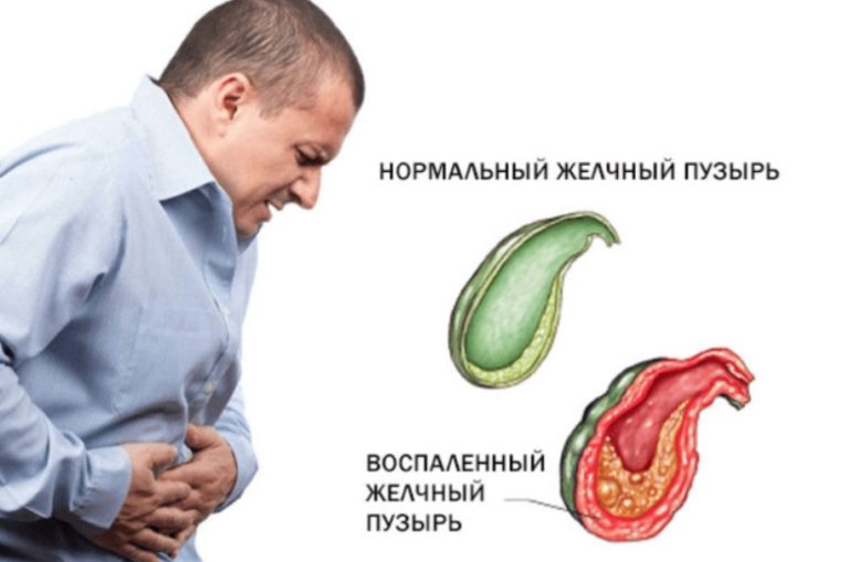 При воспаления желчного пузыря эти 3 средства придут вам на помощь