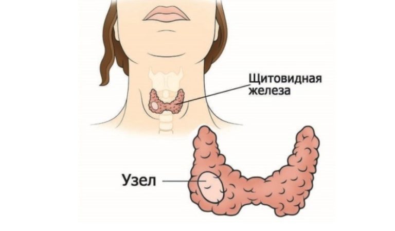 Простой домашний способ избавиться от узла на щитовидной железе