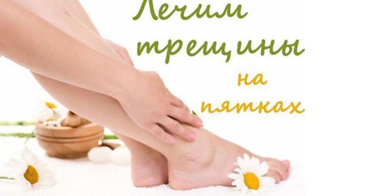 Трещины на Стопах: Лечение Натуральными Средствами