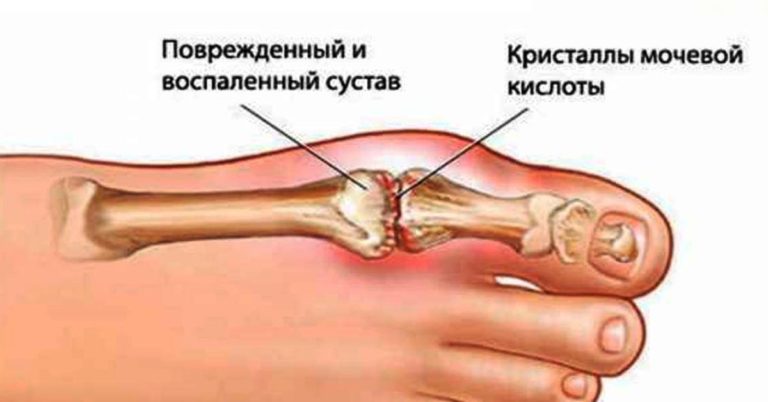 5 старинных проверенных средств устранят мочевую кислоту и избавят от болей в суставах
