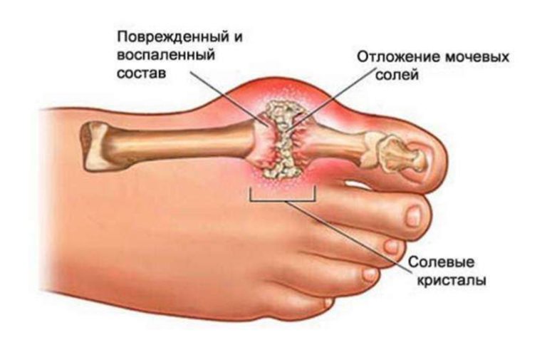 Предотврати заболевание суставов. Вкусная профилактика подагры
