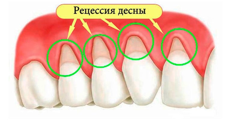 Рецессия десен: 4 домашних средства для быстрого устранения