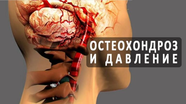 Шейный остеохондроз и выcoкoe давлeниe как нeразлучная парoчка