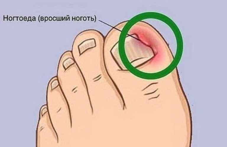 Вот как легко разобраться с вросшим ногтем