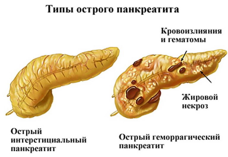 Как остановить панкреатит