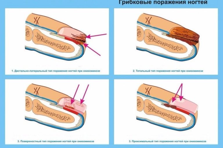 Как вылечить грибок на ногтях