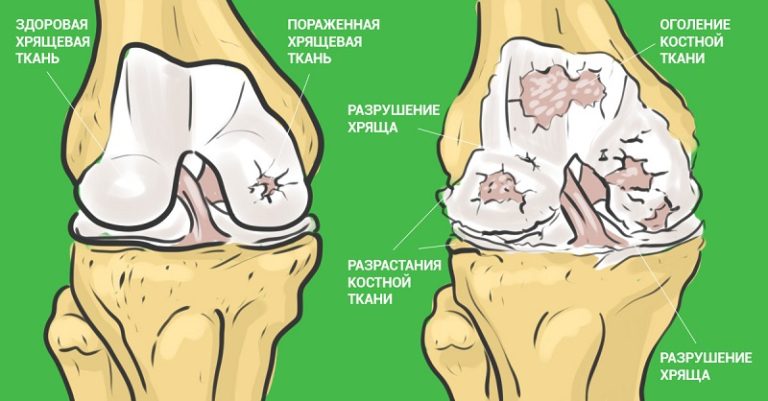 Самый эффективный способ который избавит вас от болей в суставах