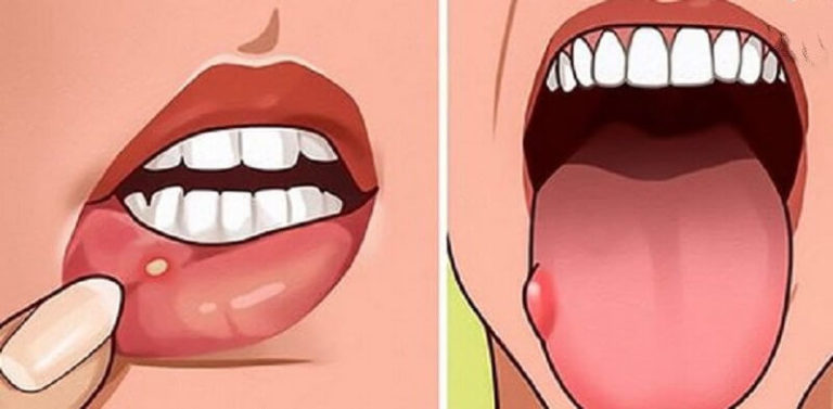 7 признаков дефицита фолиевой кислоты, которые многие игнорируют
