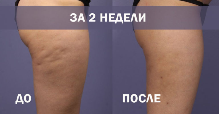 Целлюлит исчезнет волшебным образом. Древнее проверенное средство+супер эффективные упражнения