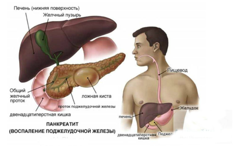 Как уберечь поджелудочную железу от воспаления: опасное заболевание