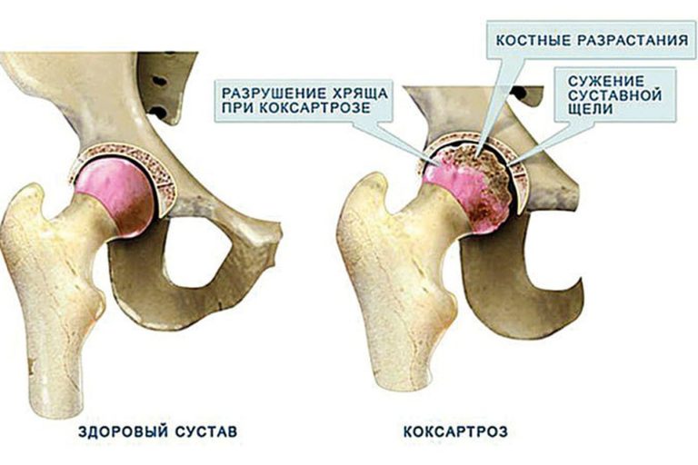Коксартроз — домашнее лечение больного сустава. Гимнастика. Профилактика. Простые рецепты